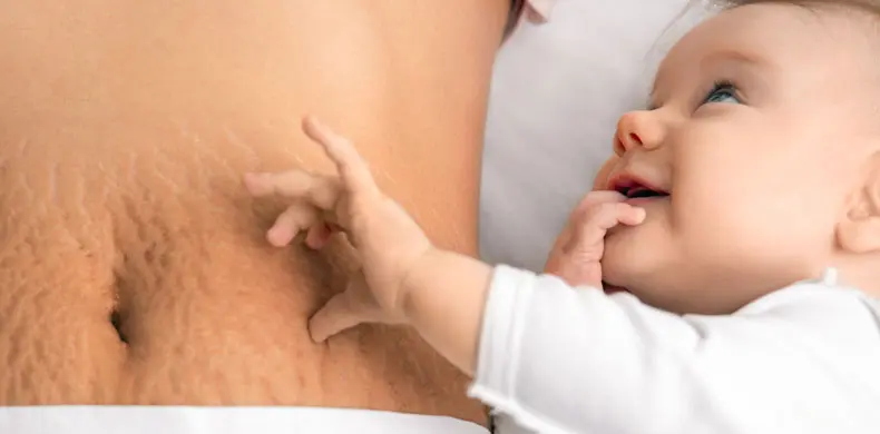 איך מתמודדים עם סימני מתיחה – מה קורה לגוף האישה לאחר לידה