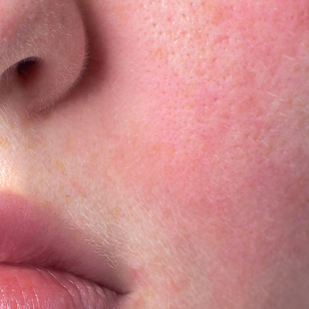 עור רגיש ואדמומי