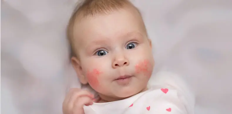 מהו ההבדל בין סבוריאה לבין עור יבש בפנים אצל תינוקות?